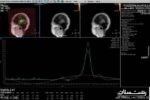 راه اندازی MRI پیشرفته بررسی ضایعات مغزی در مرکز آموزشی و درمانی پورسینا